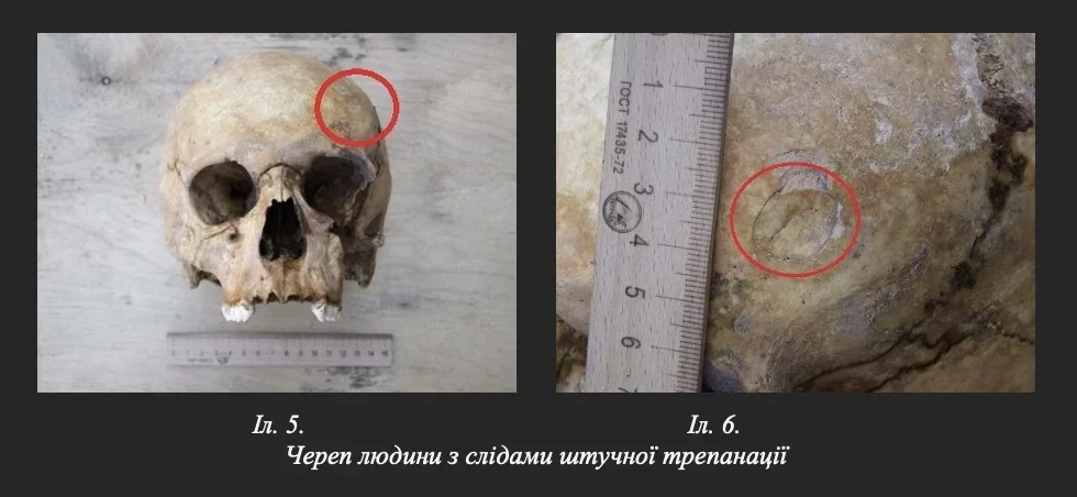 У вінницькому монастирі виявили рештки з ознаками давньої операції на черепі